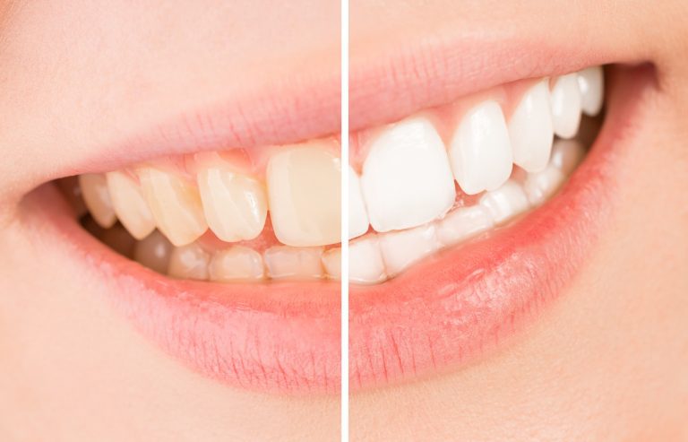 10 Teeth Whitening Tips for a Brighter Smile