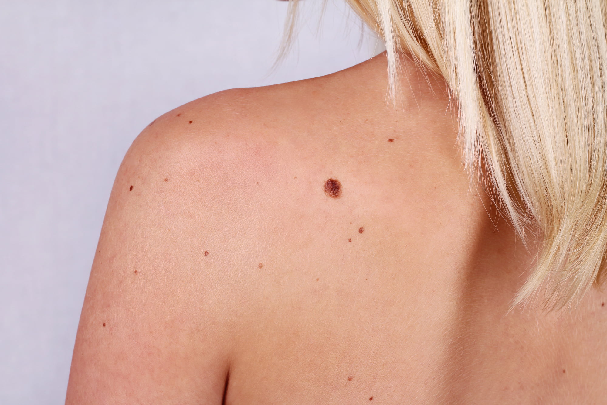 Having a comprehensive skin check done helps detect abnormalities and possible signs of skin cancer. Here's why you should schedule a skin check.