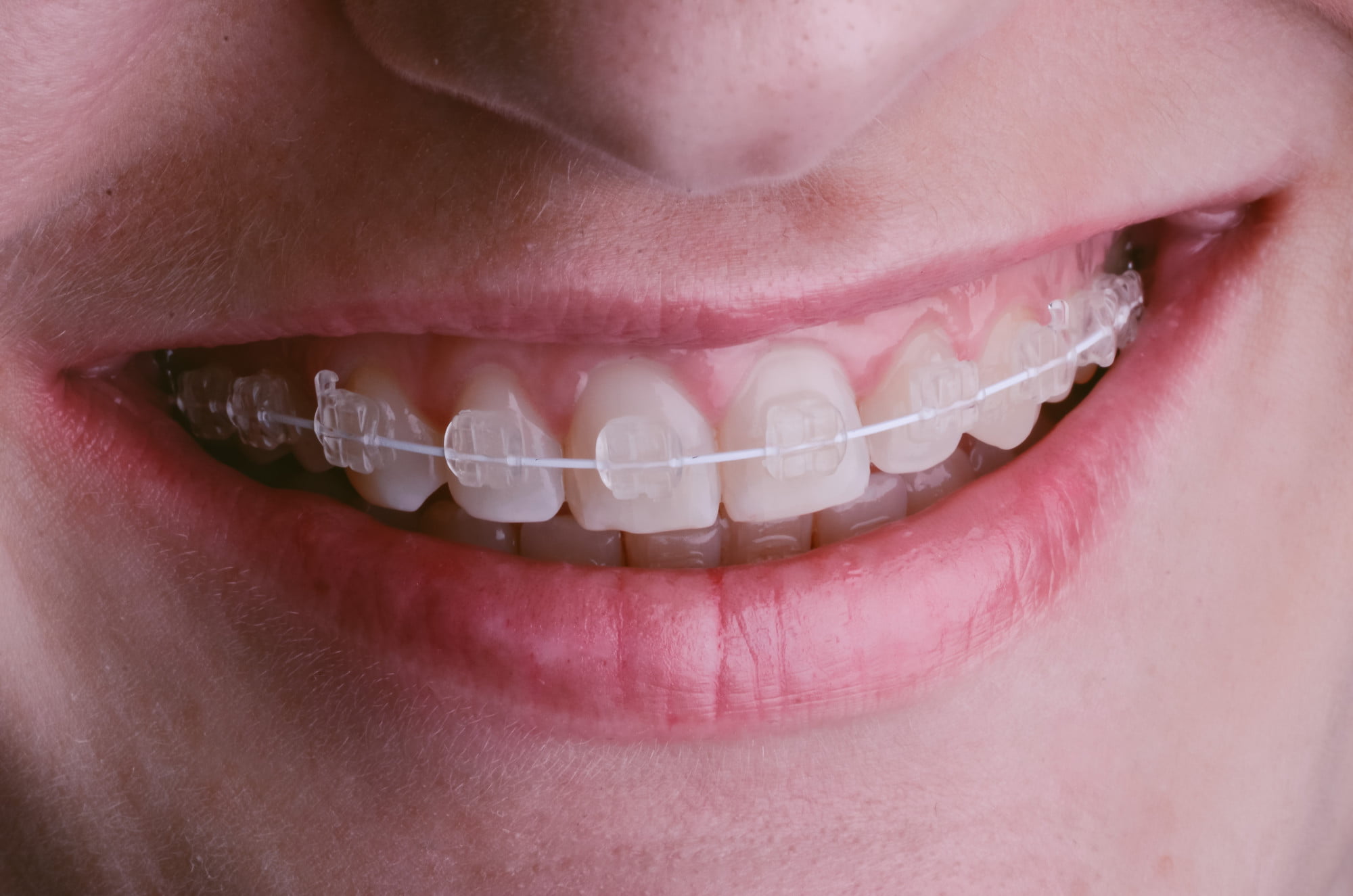 Did you know that not all dental braces are created equal these days? Here are the many different types of dental braces that exist today.