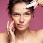 Are you wondering what the difference is between blackheads vs whiteheads on skin? Keep reading and learn more about them here.
