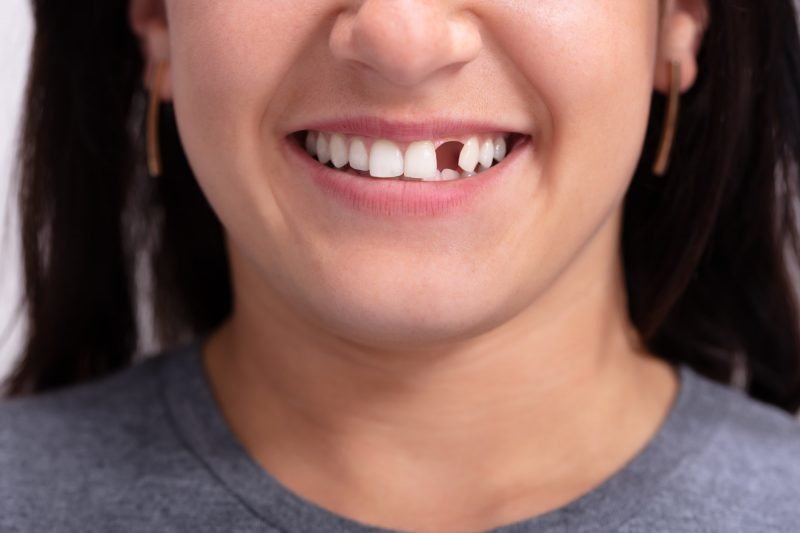 Are you wondering what options you have for replacing missing teeth? Check out our guide as we look at replacement teeth solutions and how they work.