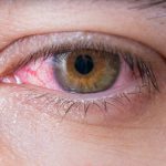 Itchiness of the eyes is a fairly common condition that can bring you major discomfort. But what causes itchy eyes? Read this article to find out.