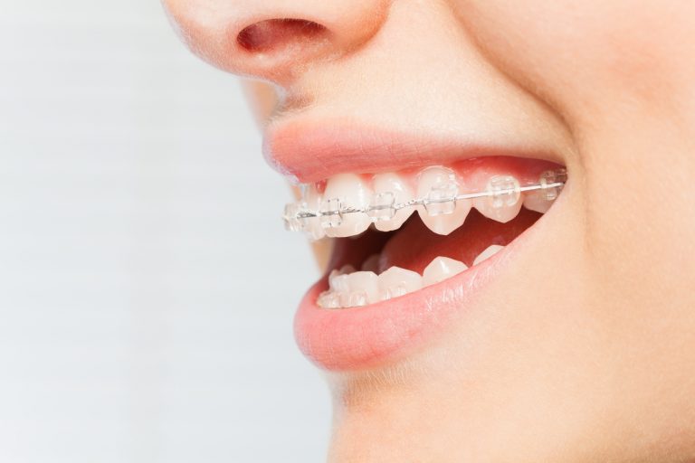 7 Teeth Straightening Options for You to Consider