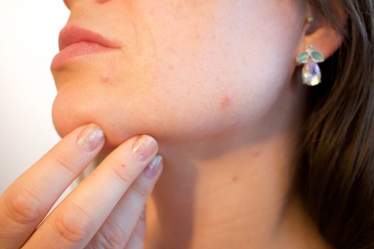 Hormonal Acne: The Causes and Treatment Options