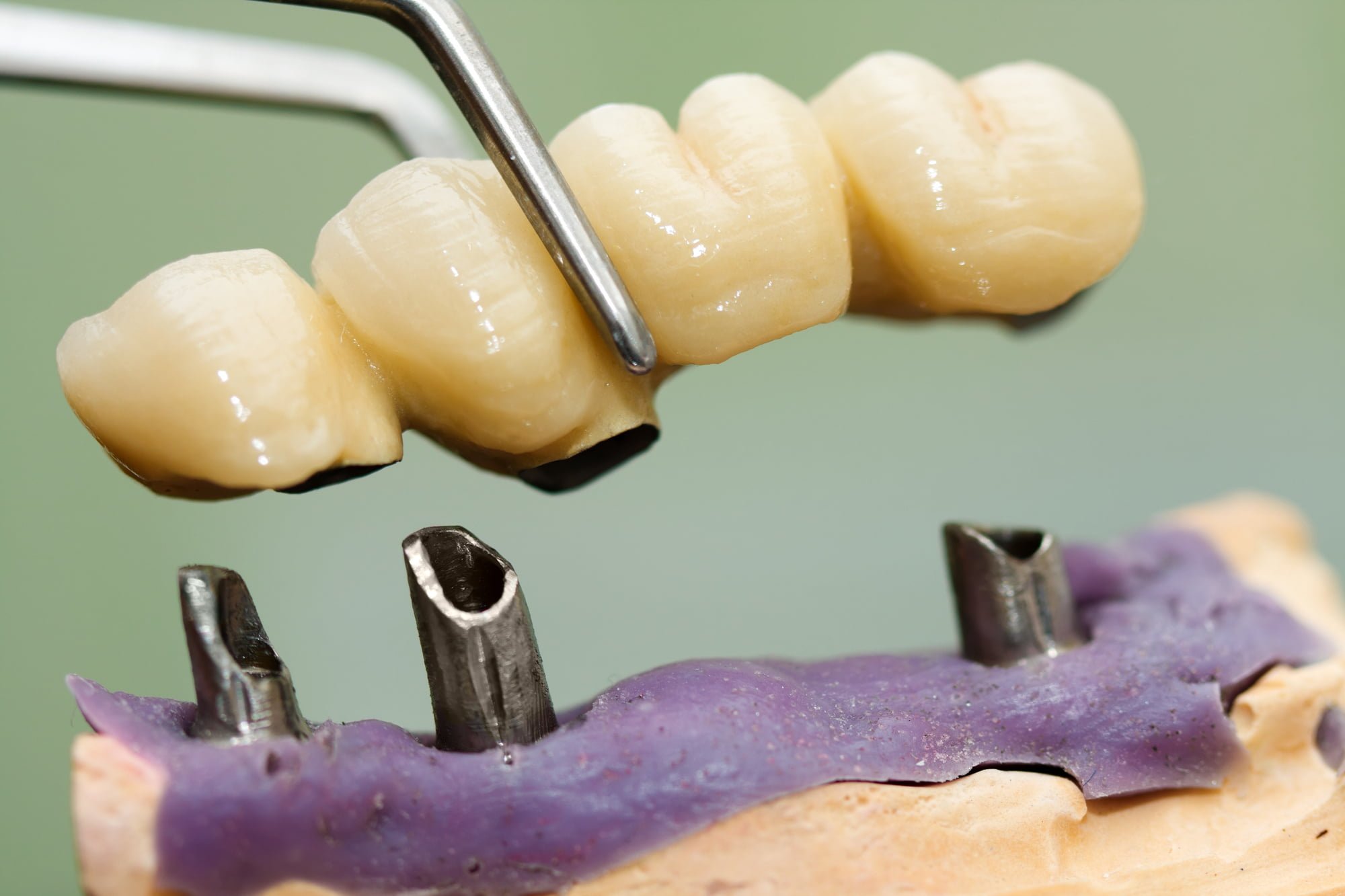 Permanent teeth implants can replace missing teeth and restore your smile. Here are five must-know things about permanent teeth implants before you get them.