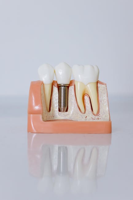 What to Expect During a Single Tooth Dental Implant