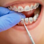 If you want to make sure your braces keep your teeth aligned, this guide can help. Here are common errors with wearing braces and how to avoid them.