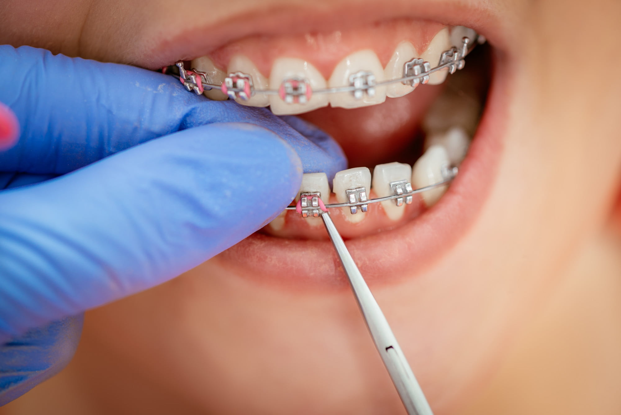 If you want to make sure your braces keep your teeth aligned, this guide can help. Here are common errors with wearing braces and how to avoid them.