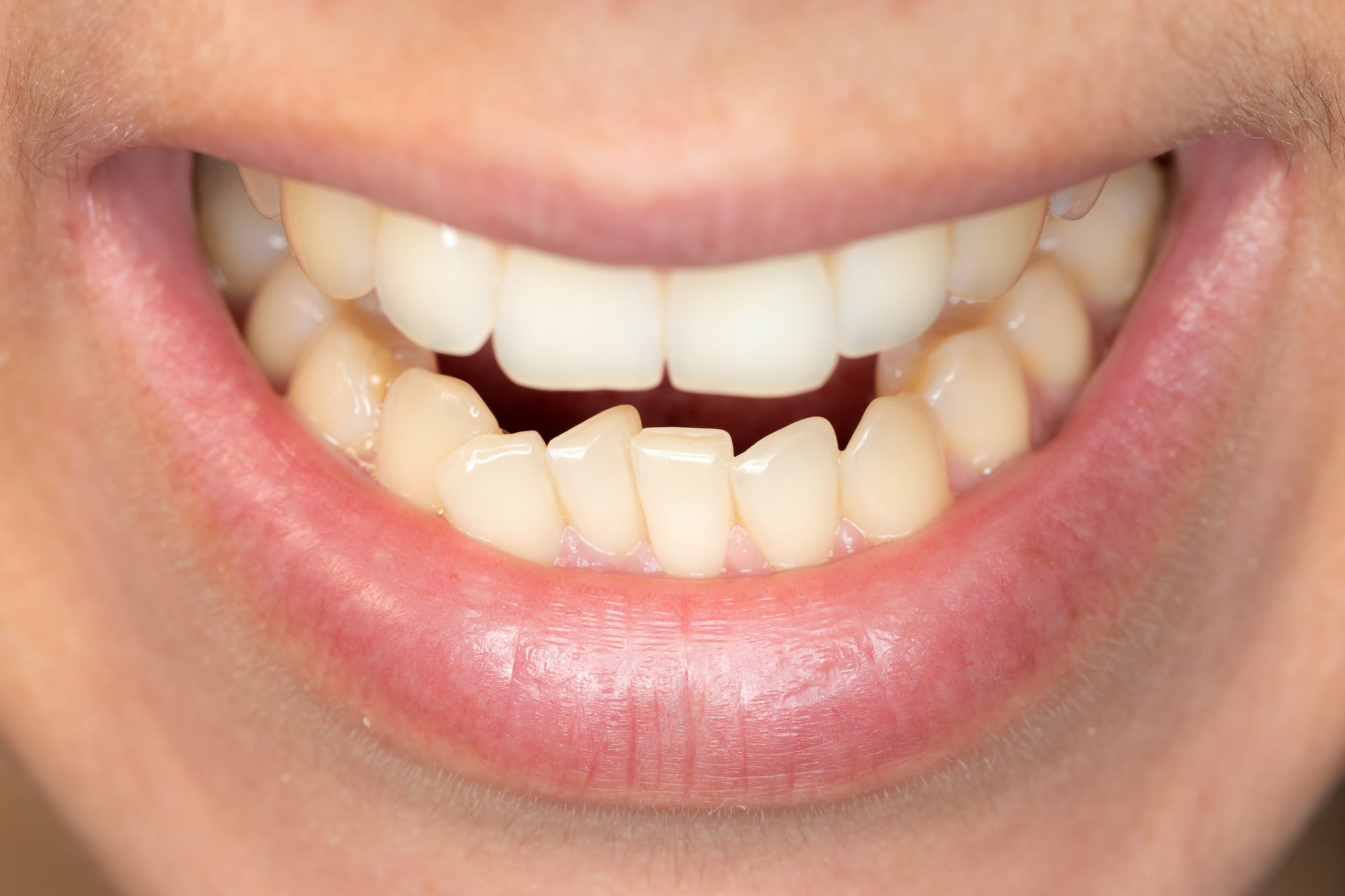 A healthy smile means teeth that are properly aligned. Here are a few common ways teeth can be misaligned and how to solve the issues.