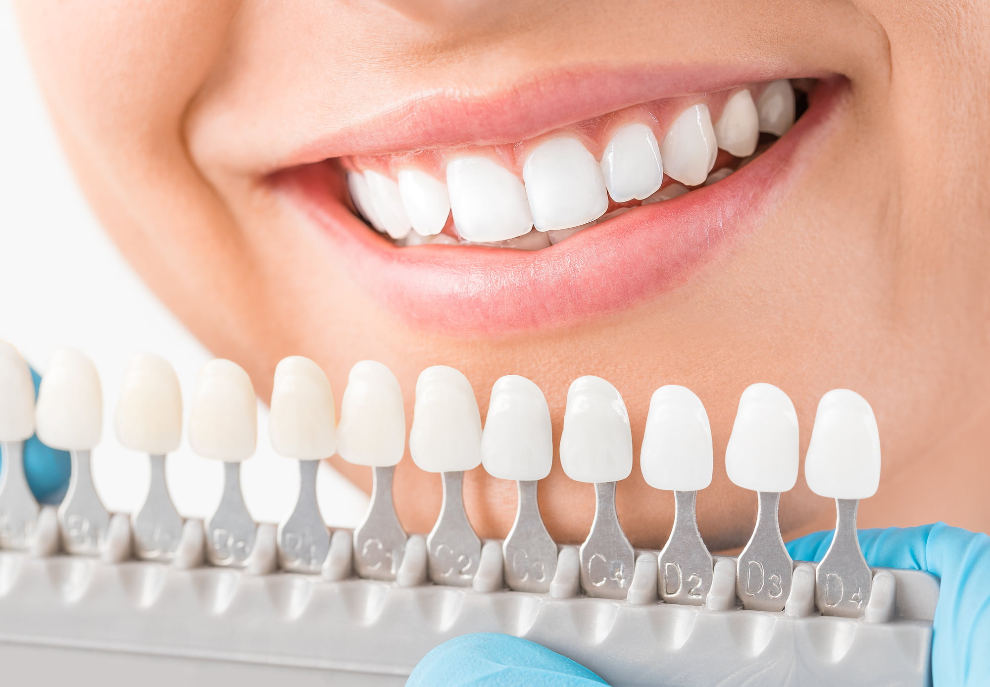 Do you know the difference between crowns vs. veneers? Here's what you need to know to decide which is the best for you.