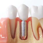 Before you get dental implants, you should know the prices you can expect to pay. Learn more about the cost of dental implants right here.