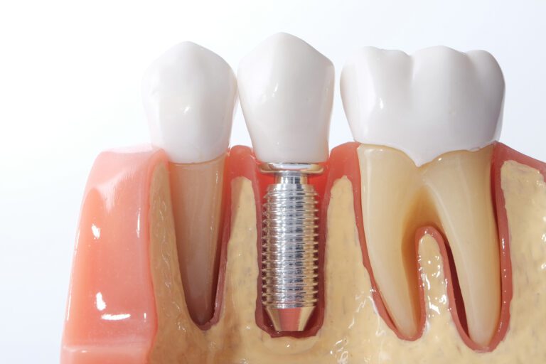 What Is the Average Cost of Dental Implants?