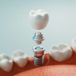 If you're presented with the option for dental implant surgery, there's no need to be nervous. Here's what the procedure is like and what to expect.