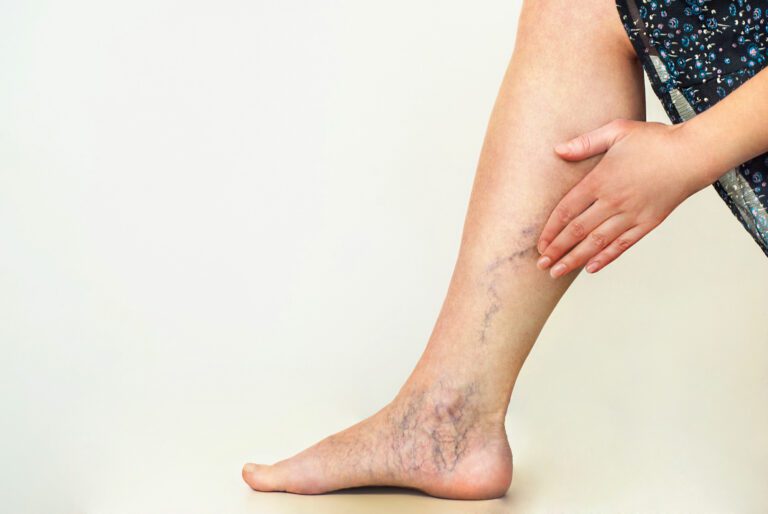 How to Choose Varicose Vein Specialists: Everything You Need to Know
