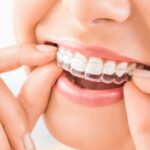 Invisalign dentists near me: Do you want to know how to choose the right Invisalign dentist? Read on to learn how to make the right choice.