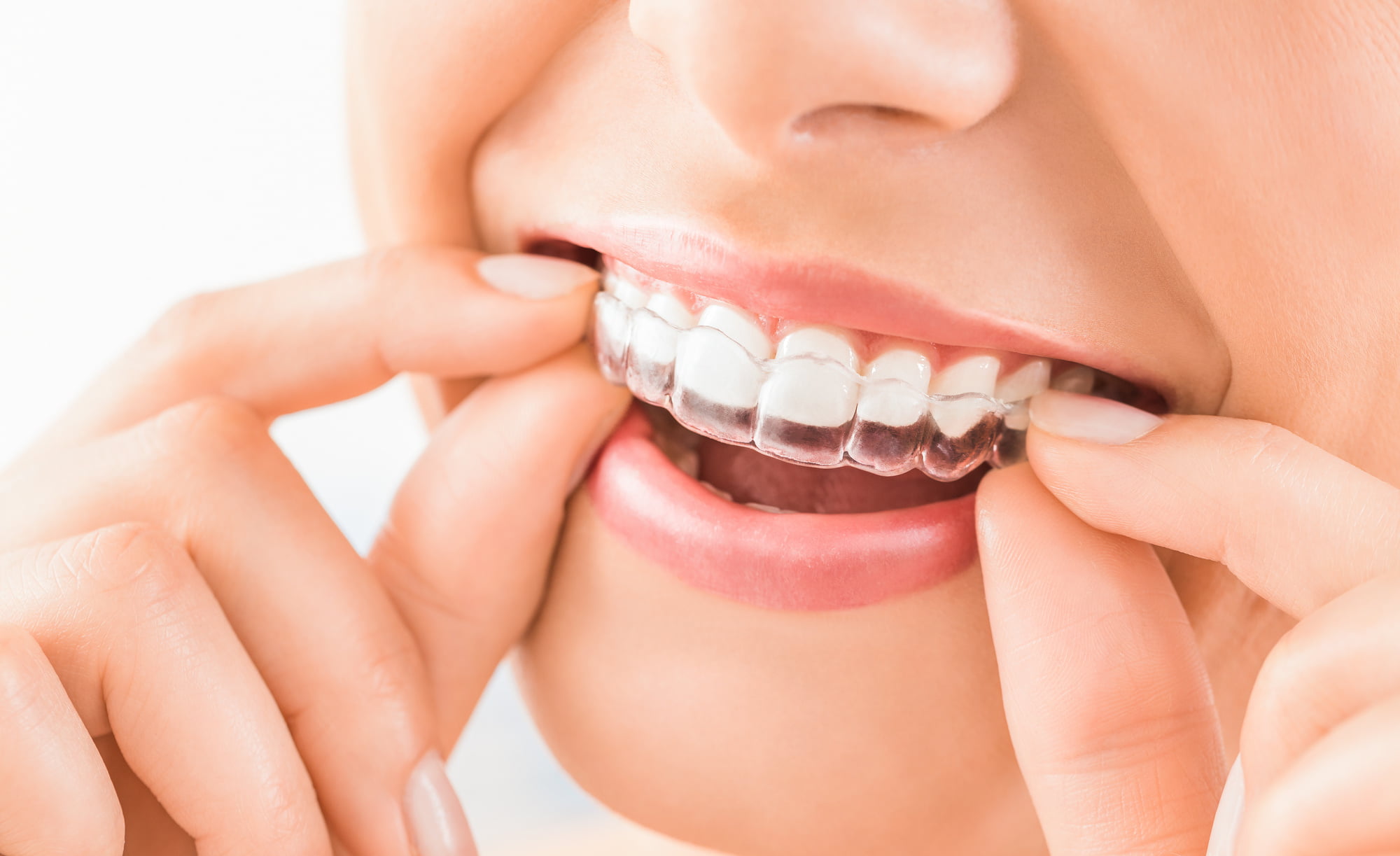 Invisalign dentists near me: Do you want to know how to choose the right Invisalign dentist? Read on to learn how to make the right choice.