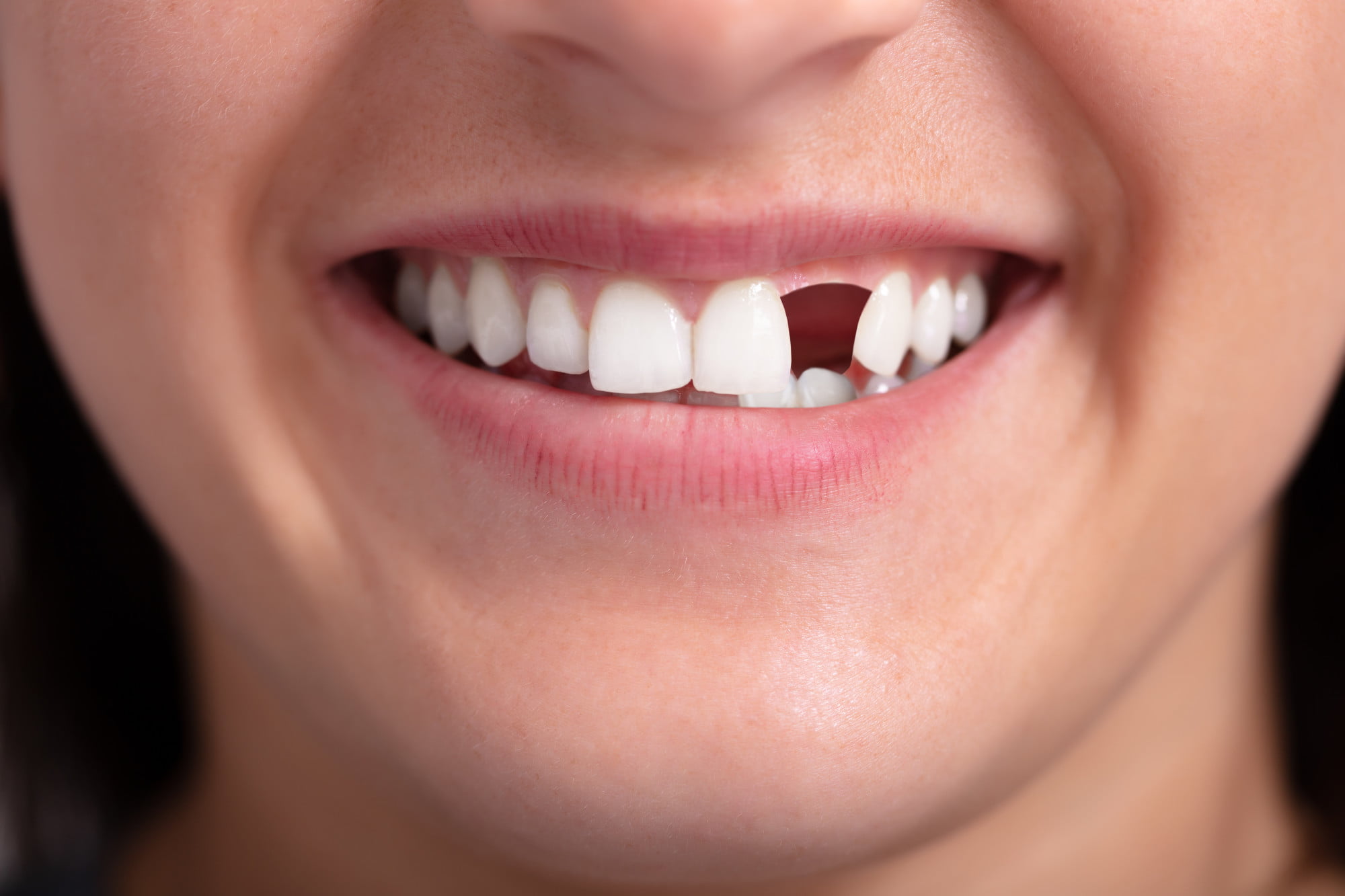 A chipped front tooth can be caused by several different things. Let's take a look at the common causes and treatment options.