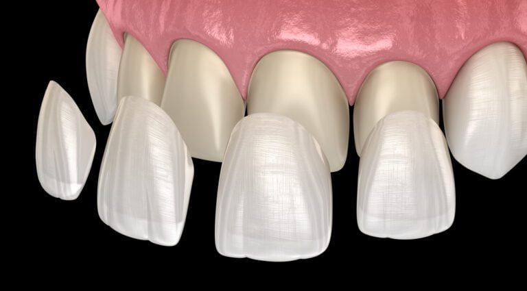 What Are the Different Types of Veneers?