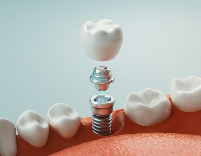 3 Dental Implant Technologies to Smile About in 2023