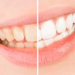 Teeth whitening is an incredibly effective treatment to improve the look of your teeth. Here's what you need to know about teeth whitening.