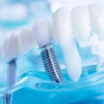 If you have one or more missing teeth, then you may want to consider dental implants. But what are dental implants exactly? Here's what you should know.