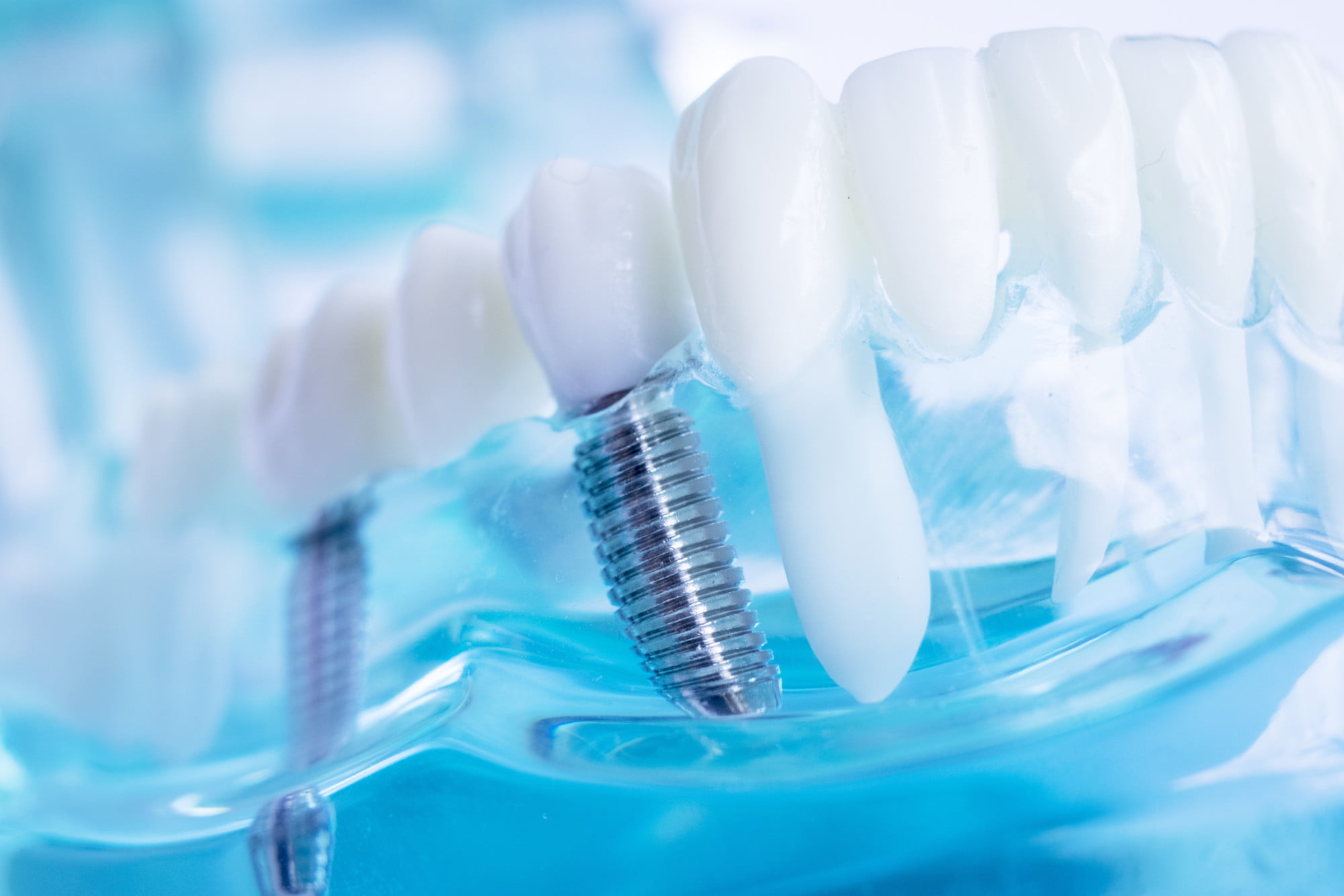 If you have one or more missing teeth, then you may want to consider dental implants. But what are dental implants exactly? Here's what you should know.