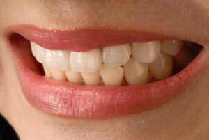 Are Veneers Permanent? And Other Frequently Asked Questions
