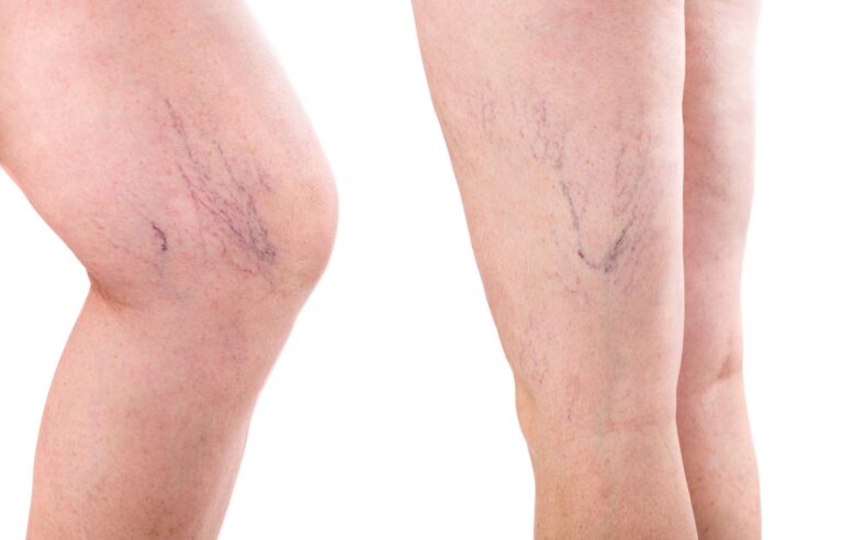 The Warning Signs: Early Stage Varicose Veins Symptoms